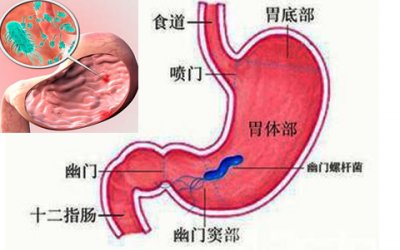 ​丁香叶能杀死幽门螺旋杆菌吗 不用担心胃炎找上你