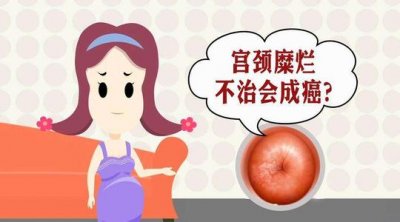 ​宫颈糜烂leep 宫颈糜烂要不要治疗？