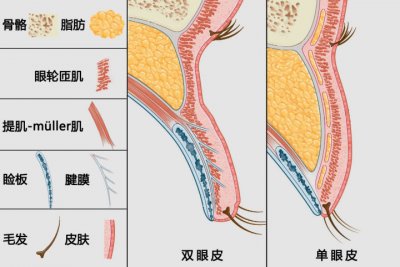 ​单眼皮如何变双 “单眼皮肿眼泡还能变成双眼皮吗？”不手术是不可能实现的