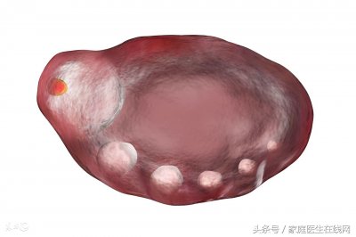 ​多囊卵巢能怀上孩子吗 医生：离不开这4个原因