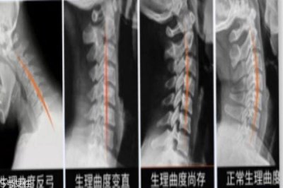 ​skg颈椎按摩仪怎么使用 要配合按摩操一起